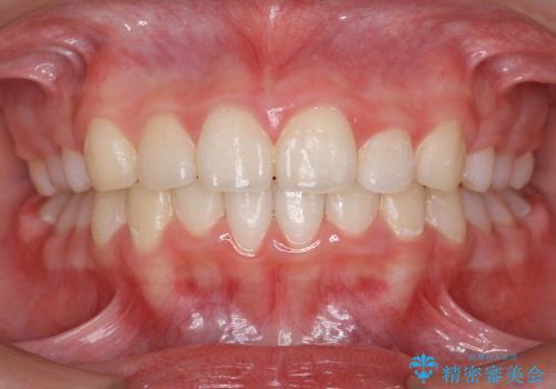 他院の引き継ぎ　過蓋(かがい)咬合・出っ歯を美しくの症例 治療後