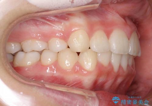 他院の引き継ぎ　過蓋(かがい)咬合・出っ歯を美しくの治療後