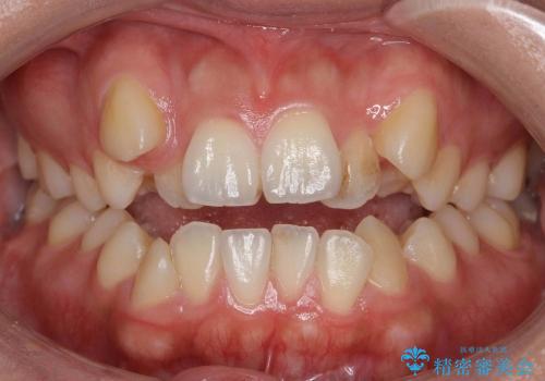 オープンバイト(開咬)　八重歯　の症例 治療前
