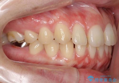 前歯のすき歯　シザーズバイトの治療前
