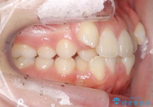前歯のがたがた　他院の拡大床矯正で治らなかったの治療前