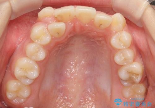 前歯のがたがた　他院の拡大床矯正で治らなかったの治療前