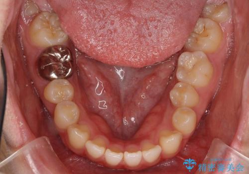 前歯のすき歯　シザーズバイトの治療前