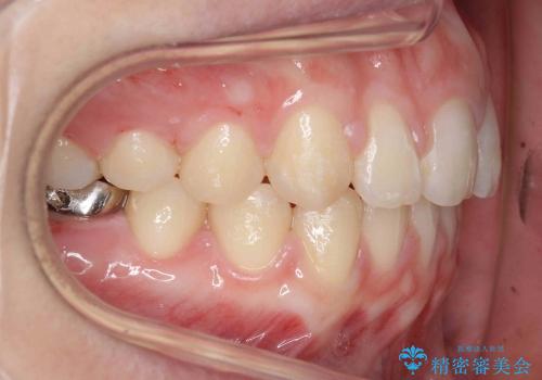 前歯のすき歯　シザーズバイトの治療後