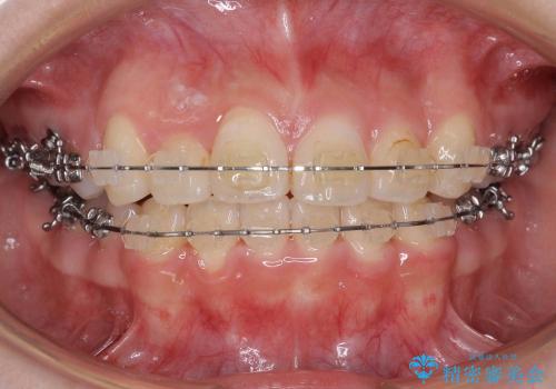 前歯のがたがた　他院の拡大床矯正で治らなかったの治療中