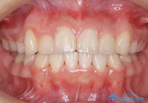 前歯のがたがた　他院の拡大床矯正で治らなかったの症例 治療後