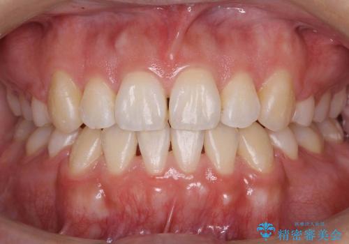 オープンバイト(開咬)　八重歯　の症例 治療後