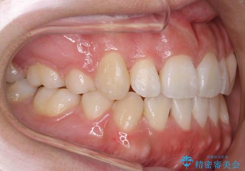 オープンバイト(開咬)　八重歯　の治療後