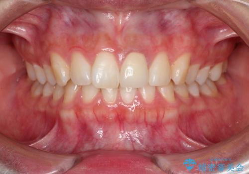 30代女性　変色した前歯　欠けた前歯　オールセラミックによる審美歯科の治療後