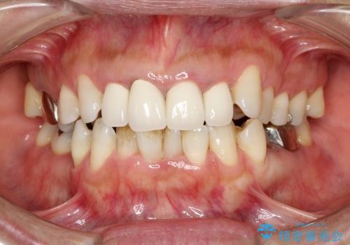 30代女性　根元から外れた歯のやりかえの症例 治療前