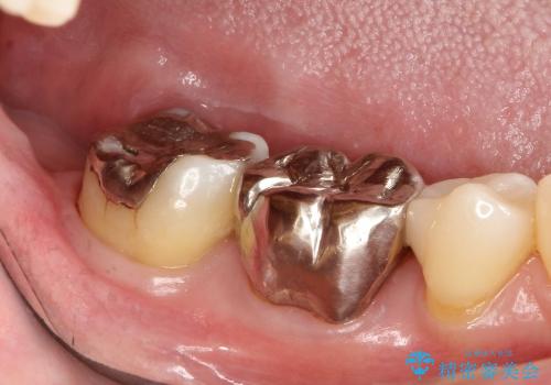 30代女性 分厚い歯ぐきを取り除く処置の治療後