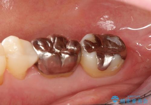 30代女性 分厚い歯ぐきを取り除く処置の治療後
