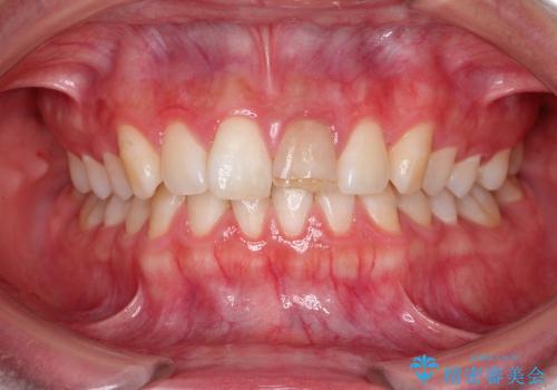 30代女性　変色した前歯　欠けた前歯　オールセラミックによる審美歯科の治療前