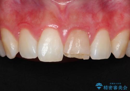 30代女性　変色した前歯　欠けた前歯　オールセラミックによる審美歯科