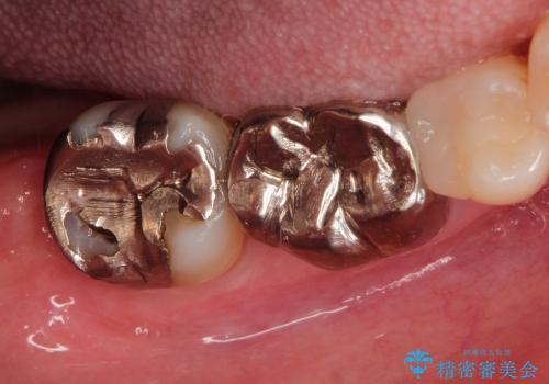 30代女性 分厚い歯ぐきを取り除く処置の治療前