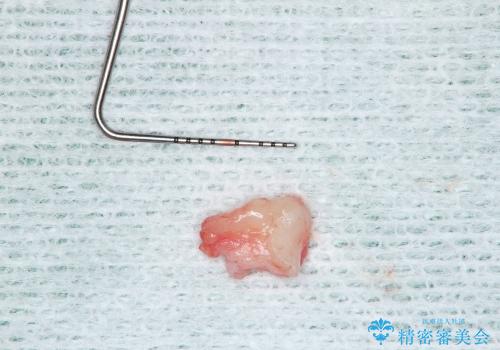 30代女性 分厚い歯ぐきを取り除く処置