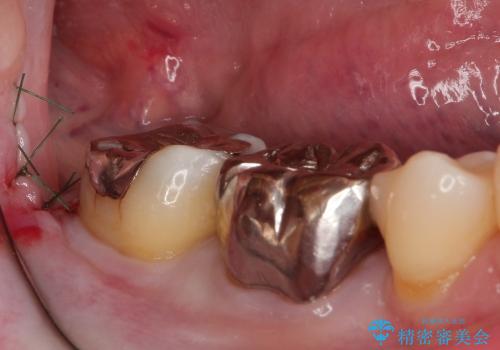 30代女性 分厚い歯ぐきを取り除く処置の治療中
