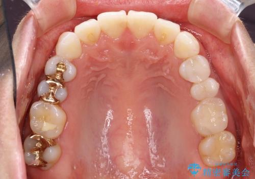 20代女性 わずかな歯並びの修正(invisalignにて)の症例 治療後