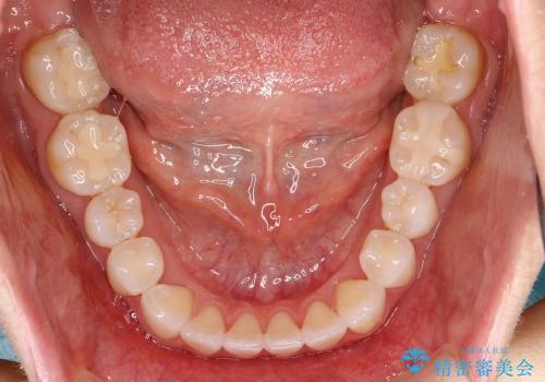 20代女性 わずかな歯並びの修正(invisalignにて)の治療後