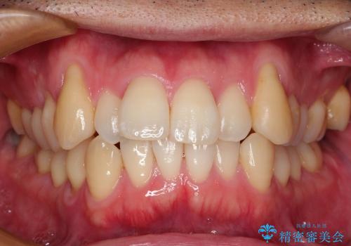 犬歯　歯ぐきの移植　三年経過症例の治療前
