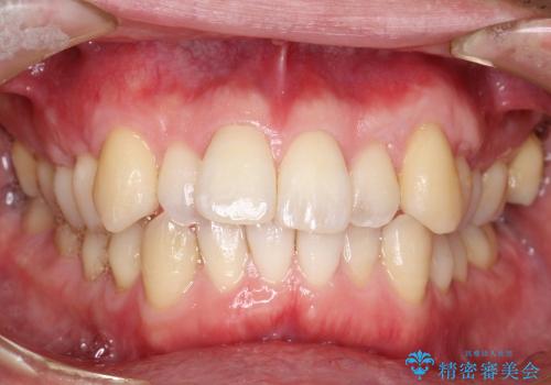 犬歯　歯ぐきの移植　三年経過症例の治療中