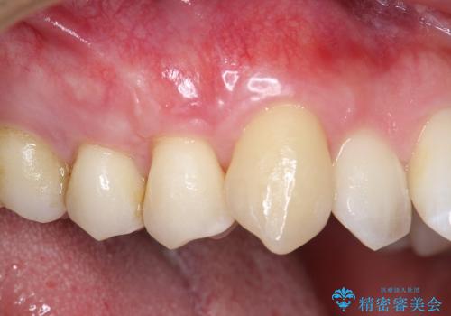 犬歯　歯ぐきの移植　三年経過症例の治療中