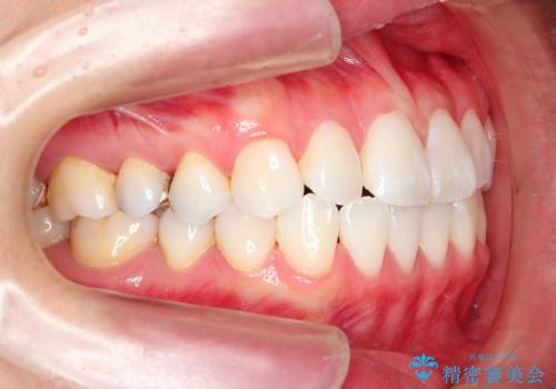 20代女性 わずかな歯並びの修正(invisalignにて)の治療前
