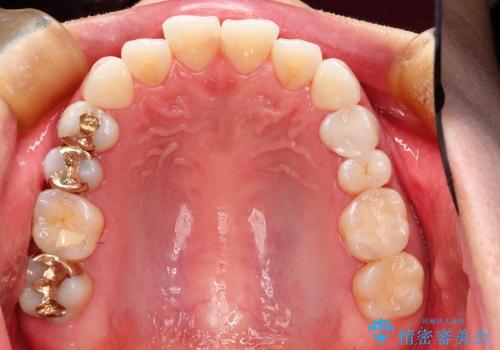 20代女性 わずかな歯並びの修正(invisalignにて)の症例 治療前