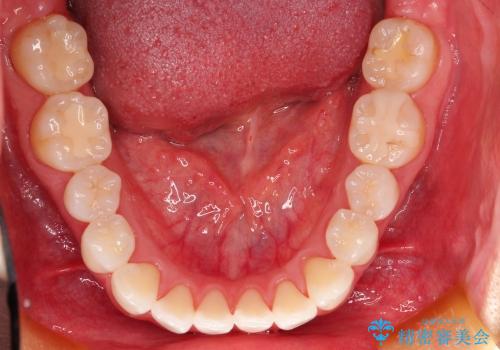 20代女性 わずかな歯並びの修正(invisalignにて)の治療前