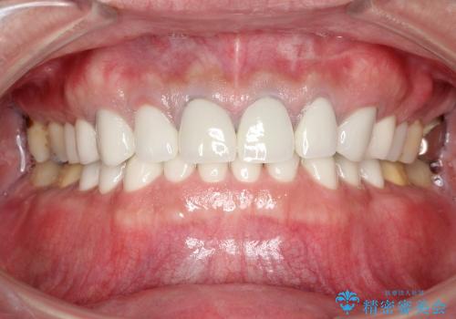 前歯を含む複数歯のセラミック治療の治療後