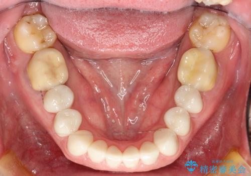 前歯を含む複数歯のセラミック治療の治療後