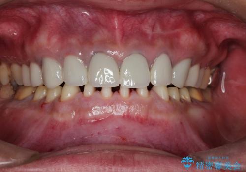 前歯を含む複数歯のセラミック治療の治療中