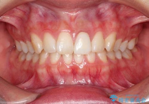 30代女性　変色した前歯　欠けた前歯　オールセラミックによる審美歯科の治療中