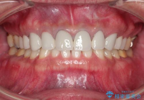 前歯を含む複数歯のセラミック治療の症例 治療前