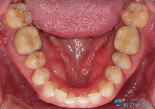 前歯を含む複数歯のセラミック治療の治療前