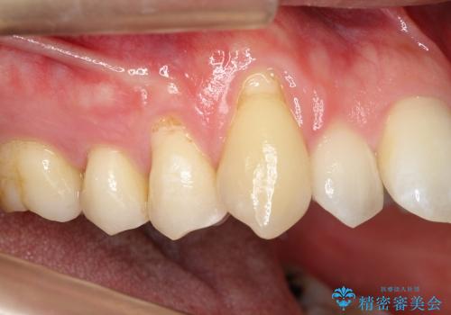 犬歯　歯ぐきの移植　三年経過症例の治療前