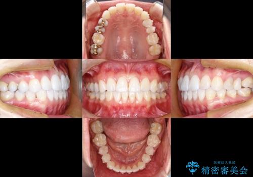 20代女性 わずかな歯並びの修正(invisalignにて)の治療中