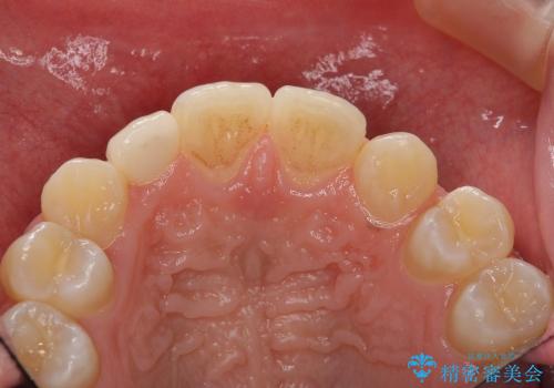 矮小歯の形態改善の治療後