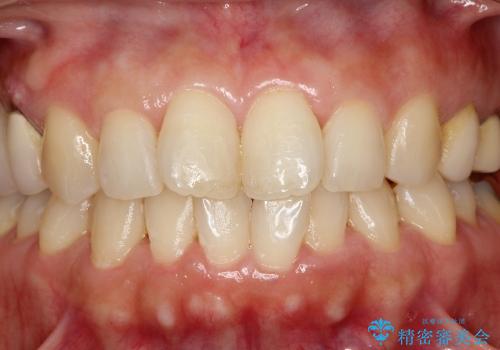 臼歯部ブリッジ治療 (インプラントを用いない咬合回復の治療前