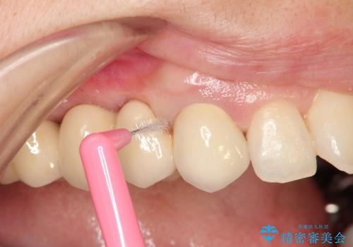 臼歯部ブリッジ治療 (インプラントを用いない咬合回復の治療中