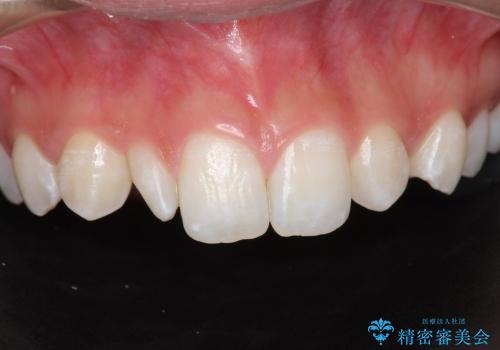 矮小歯の形態改善の治療前