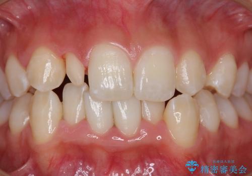 矮小歯の形態改善の治療中