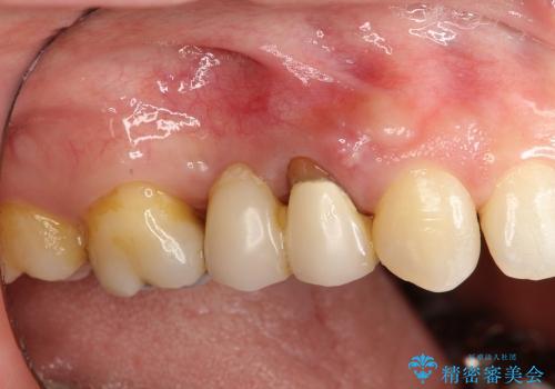 臼歯部ブリッジ治療 (インプラントを用いない咬合回復の症例 治療前