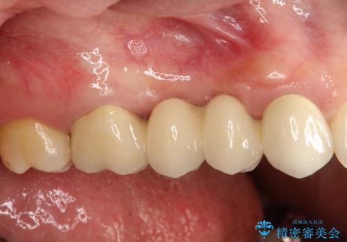 臼歯部ブリッジ治療 (インプラントを用いない咬合回復の症例 治療後