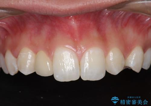 矮小歯の形態改善