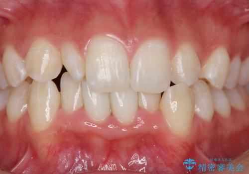 矮小歯の形態改善の治療前