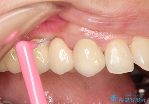 臼歯部ブリッジ治療 (インプラントを用いない咬合回復の治療中