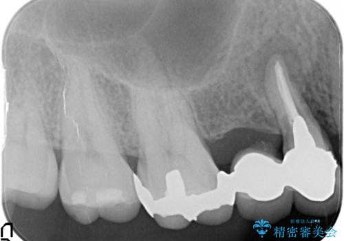 臼歯部ブリッジ治療 (インプラントを用いない咬合回復の治療前
