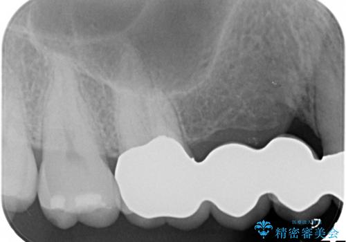 臼歯部ブリッジ治療 (インプラントを用いない咬合回復の治療後