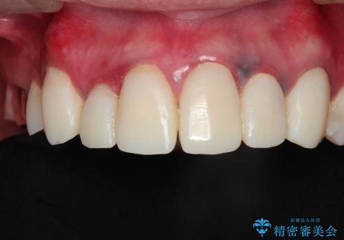 20代男性　前歯の保険クラウンをセラミッククラウンへ　歯肉の変色も改善の治療中